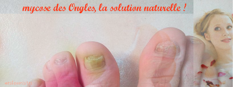 Mycose-des-ongles-la- solution-naturelle